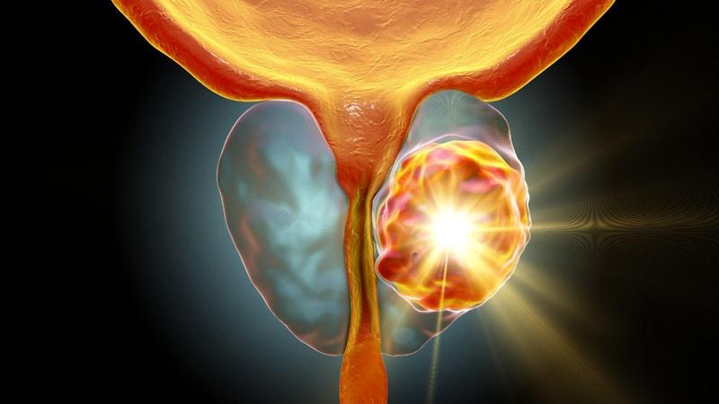 1 mm positive margin prostatectomy