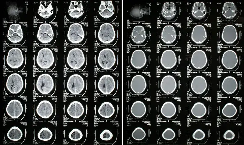 acute on chronic subdural hematoma icd-10