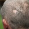 Reporting Alopecia Areata using ICD -10 Codes