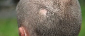 Reporting Alopecia Areata using ICD -10 Codes