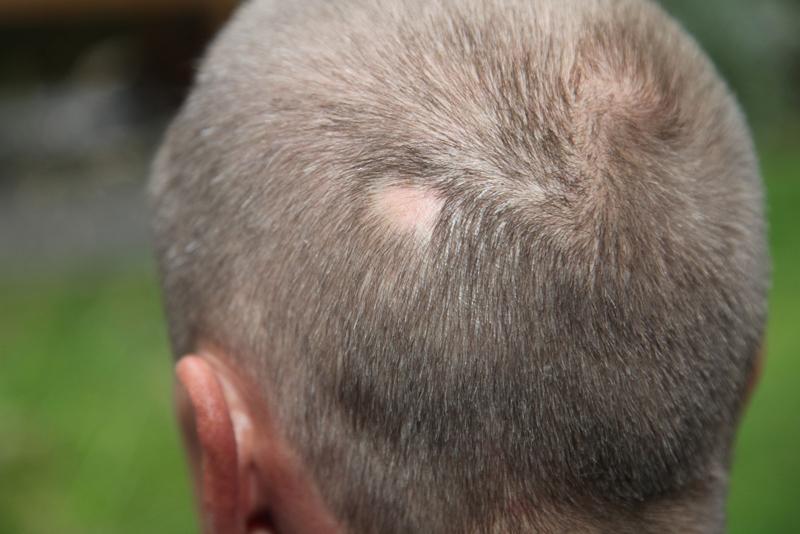 alopecia areata icd 10 code