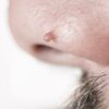 What Are Skin Tags & What Can I Do About Them?