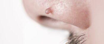 What Are Skin Tags & What Can I Do About Them?