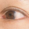 Vision Care Expert Discusses the Challenges of Living with Pterygium