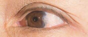 Vision Care Expert Discusses the Challenges of Living with Pterygium