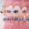 Braces Colors Ideas