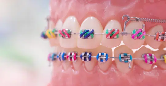 colored rubber bands for braces