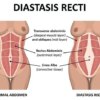 Diastasis Recti Surgery: Repairing Separated Abdominal Muscles