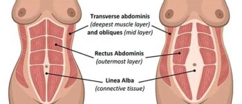 Diastasis Recti Surgery: Repairing Separated Abdominal Muscles