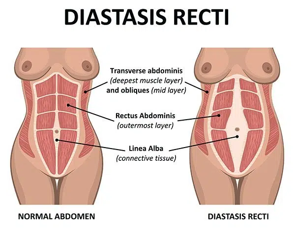 diastasis surgery before and after