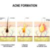 Acne 101 - for Massage Therapists, Spa & Salon Service Providers