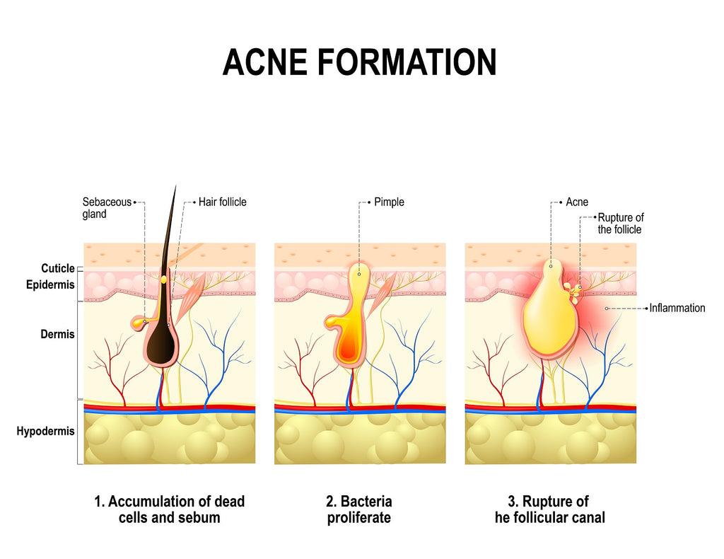 do masseuses care about back acne