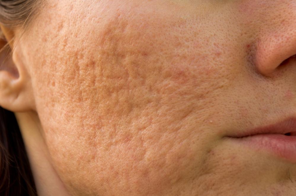 does dermaplaning help with acne scars