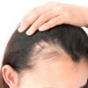 Does Hyperparathyroidism Cause Hair Loss?