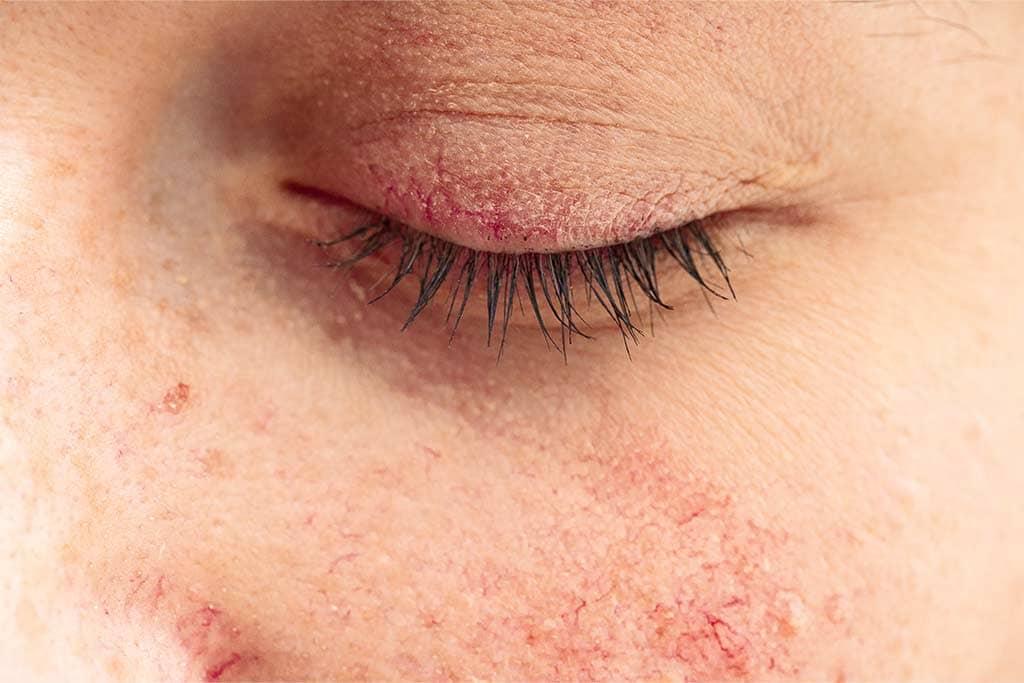 does red light help rosacea