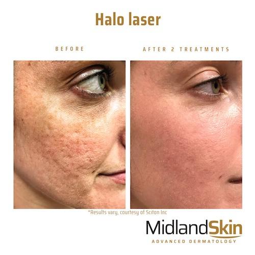 halo laser for acne scars before and after