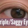 Fix Triple Eyelids