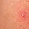 How to fix ingrown hairs in your pubic area