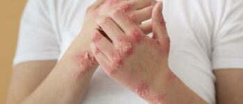 Coding Dermatitis – An Overview of the Symptoms and ICD-10 Codes