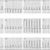 Atrial Tachycardia: Diagnosis