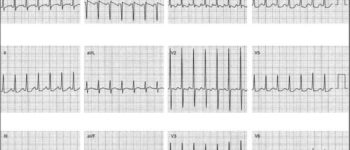 Atrial Tachycardia: Diagnosis