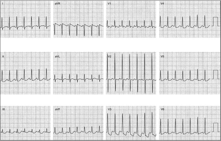 icd 10 multifocal atrial tachycardia