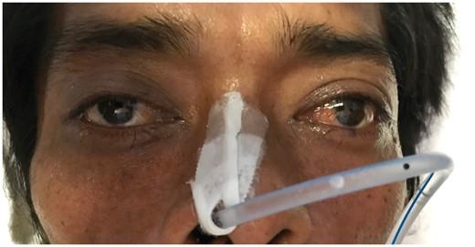 Ice pack test—an useful bedside test to diagnose myasthenia gravis