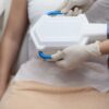 CoolSculpting vs Cryolipolysis