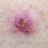 Common skin cancer can signal increased risk of other cancers