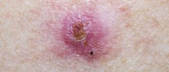 Common skin cancer can signal increased risk of other cancers