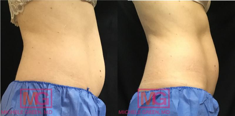 kybella for stomach fat before and after