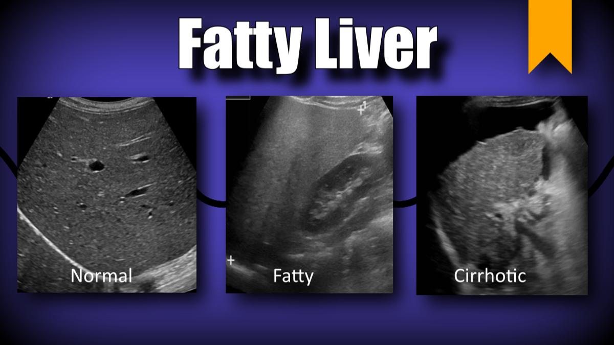 liver is homogeneous in echotexture