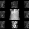 How to Document Spondylolisthesis with Accurate ICD-10 Codes