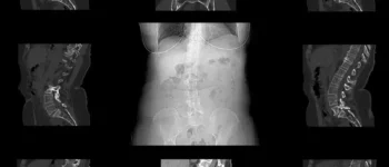 How to Document Spondylolisthesis with Accurate ICD-10 Codes