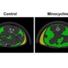 The fat tax: Long-term, systemic antibiotic use for the treatment of adolescent acne can promote fat accumulation