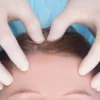 Understanding Mohs Surgery on the Scalp: Before, After, and What to Expect