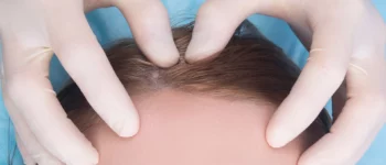 Understanding Mohs Surgery on the Scalp: Before, After, and What to Expect