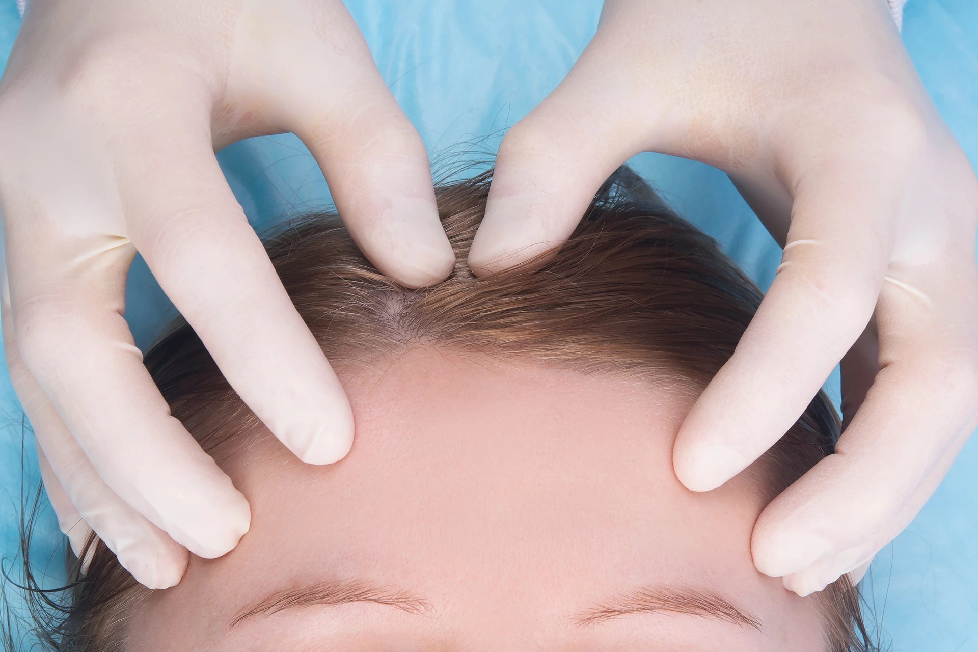 mohs surgery on scalp hair loss