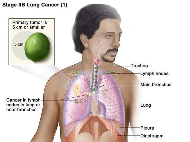 new treatment for alk-positive lung cancer