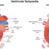 Cardiology Coding Alert