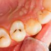 Teeth Rotting from the Inside Out: Causes, Prevention, and Treatment