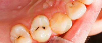 Teeth Rotting from the Inside Out: Causes, Prevention, and Treatment