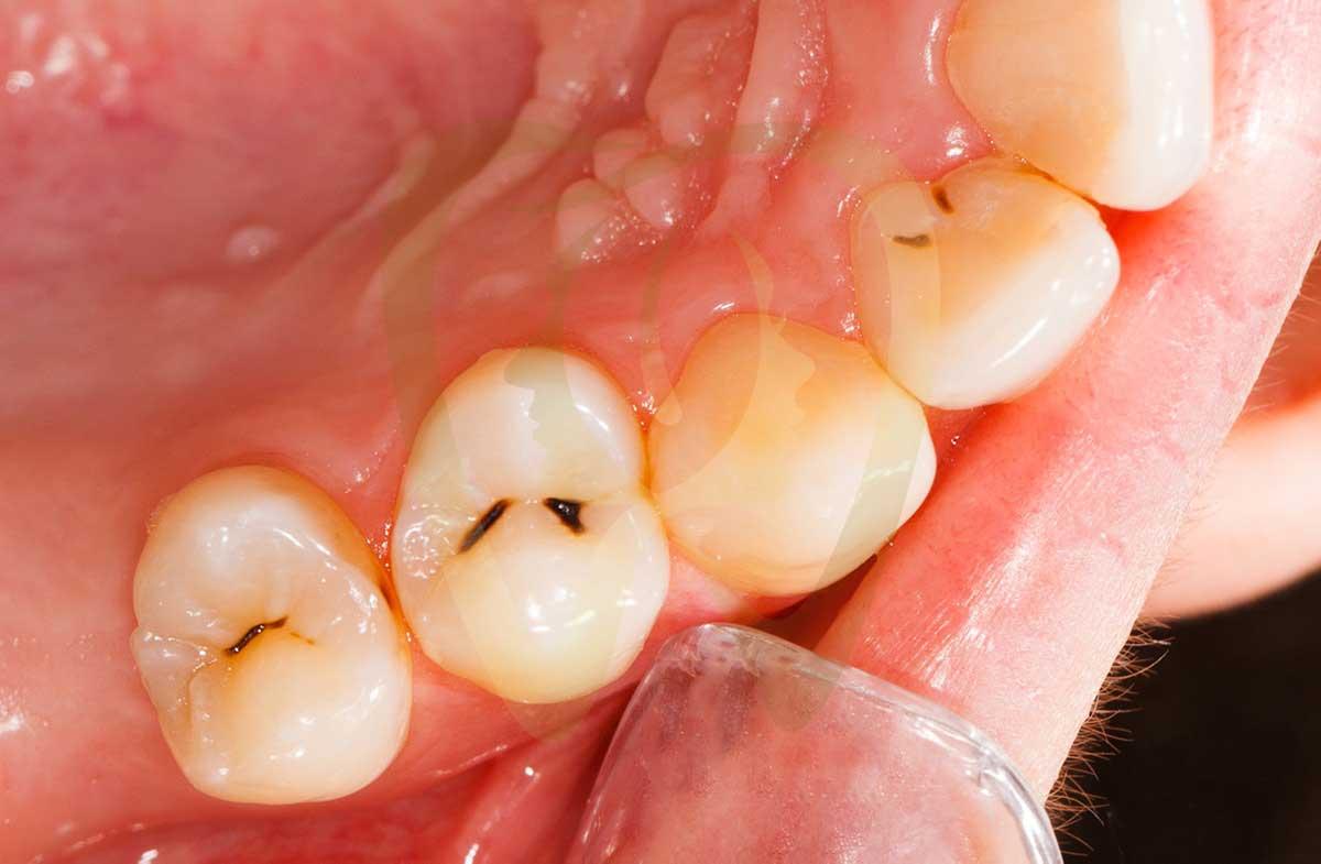 teeth rot from inside out