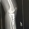 Inspiring Tibial Plateau Fracture Recovery Blog (Series)