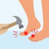 What Does Gout Pain Feel Like? How to Tell If Your Pain and Swelling Is Gout