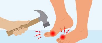 What Does Gout Pain Feel Like? How to Tell If Your Pain and Swelling Is Gout