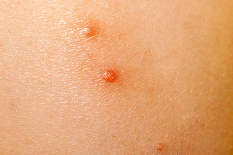 zinc oxide cream for molluscum contagiosum