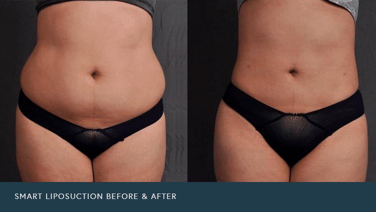 before and after smart liposuction