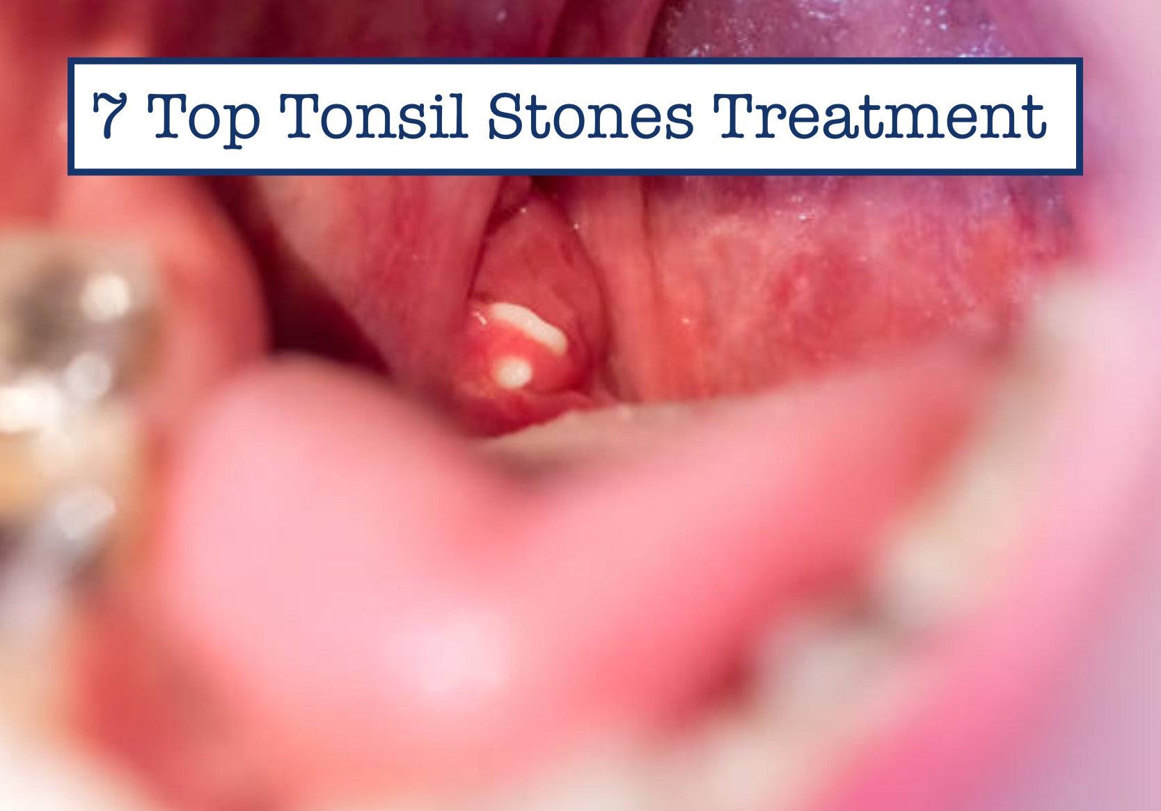 best probiotic for tonsil stones