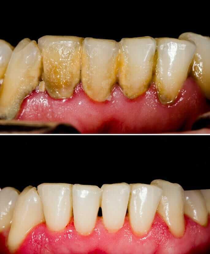 blood clots after deep cleaning